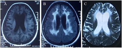 Case report: A compound heterozygous mutations in ARSA associated with adult-onset metachromatic leukodystrophy